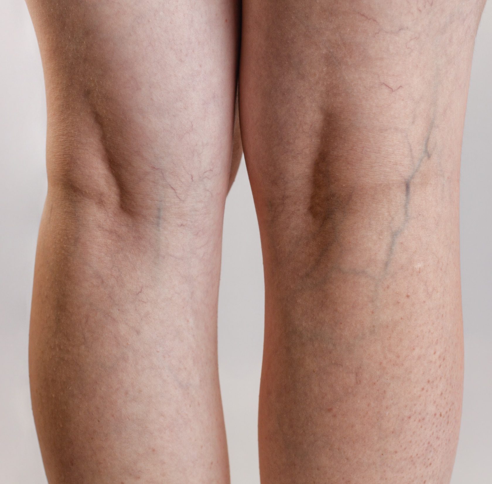 Capillari gambe laser a Negrar | D'Aloja