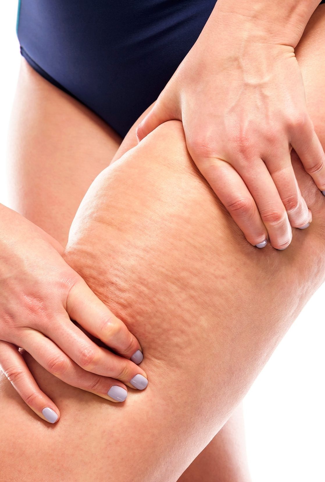 Trattamento cellulite a Negrar | Studio D'Aloja